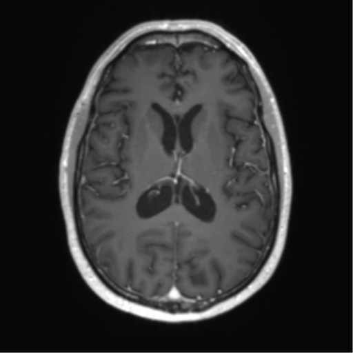 Acute disseminated encephalomyelitis (ADEM) (Radiopaedia 65319-74350 Axial T1 C+ 35).png