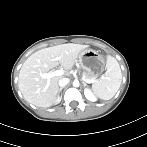 Acute gangrenous appendicitis with perforation (Radiopaedia 40152-42662 Axial C+ portal venous phase 16).png