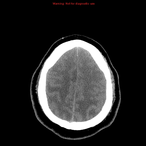 Acute hemorrhagic leukoencephalitis (Radiopaedia 14076-13920 Axial non-contrast 40).jpg