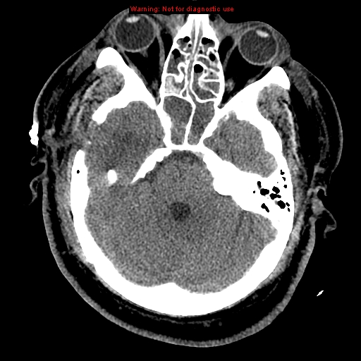 Acute hemorrhagic leukoencephalitis (Radiopaedia 14076-43697 Axial non-contrast 13).jpg