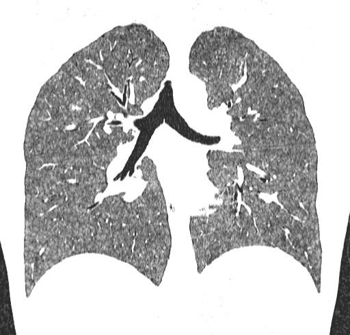 Acute hypersensitivity pneumonitis (Radiopaedia 85293-100870 Coronal lung window 75).jpg