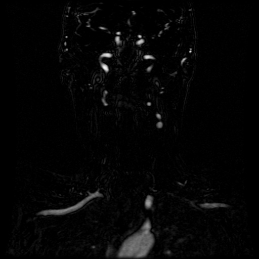 Acute internal carotid artery dissection (Radiopaedia 53541-59632 Coronal MRA 41).jpg
