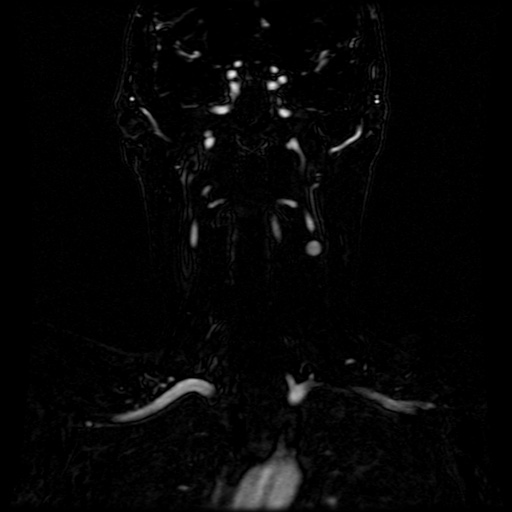 Acute internal carotid artery dissection (Radiopaedia 53541-59632 Coronal MRA 45).jpg