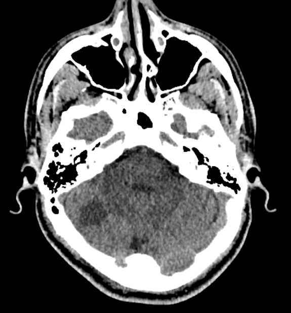 Acute ischemic stroke - posterior circulation territory (Radiopaedia 77670-89881 non-contrast 20).jpg