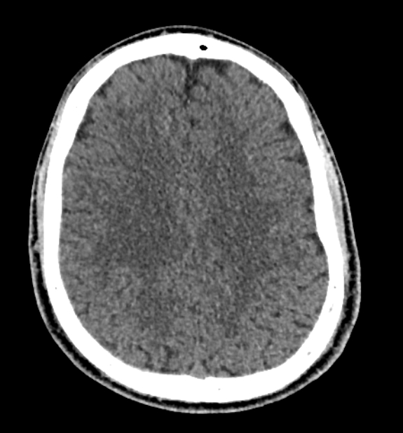 Acute ischemic stroke - posterior circulation territory (Radiopaedia 77670-89881 non-contrast 62).jpg