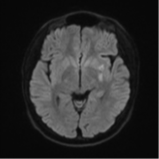 Acute left middle cerebral artery territory infarct with clot retrieval (Radiopaedia 47732-52433 Axial DWI 44).png