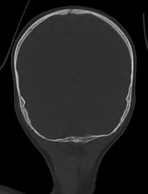 Acute mastoiditis (Radiopaedia 82678-96881 Coronal bone window 62).jpg