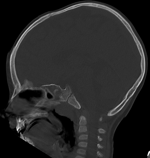 Acute mastoiditis (Radiopaedia 82678-96881 Sagittal bone window 32).jpg