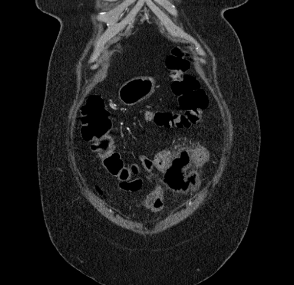 Acute mesenteric ischemia (Radiopaedia 80029-93316 Coronal C+ arterial phase 16).jpg