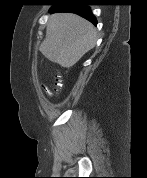 Acute mesenteric venous ischemia (Radiopaedia 46041-50383 Sagittal C+ portal venous phase 16).jpg
