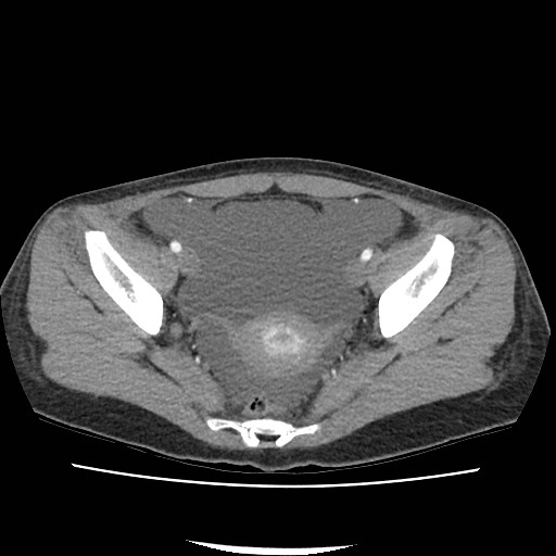 Acute myocarditis (Radiopaedia 55988-62613 Axial C+ portal venous phase 68).jpg