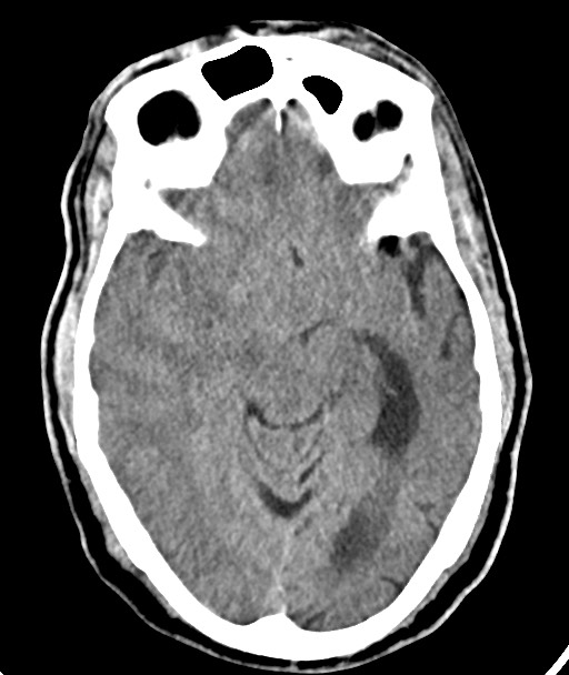 Acute on chronic subdural hematoma (Radiopaedia 78346-90966 Axial non-contrast 28).jpg