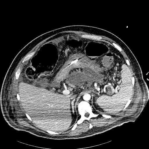 File:Acute pancreatic necrosis (Radiopaedia 13560-18502 Axial C+ portal venous phase 13).jpg