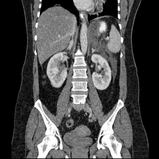 File:Acute pancreatitis (Radiopaedia 20829-20744 Coronal C+ portal venous phase 34).jpg