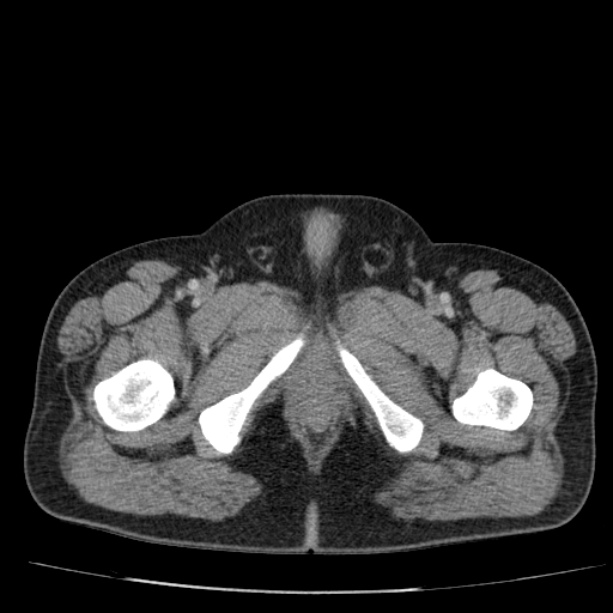 Acute pancreatitis (Radiopaedia 26663-26813 Axial C+ portal venous phase 92).jpg