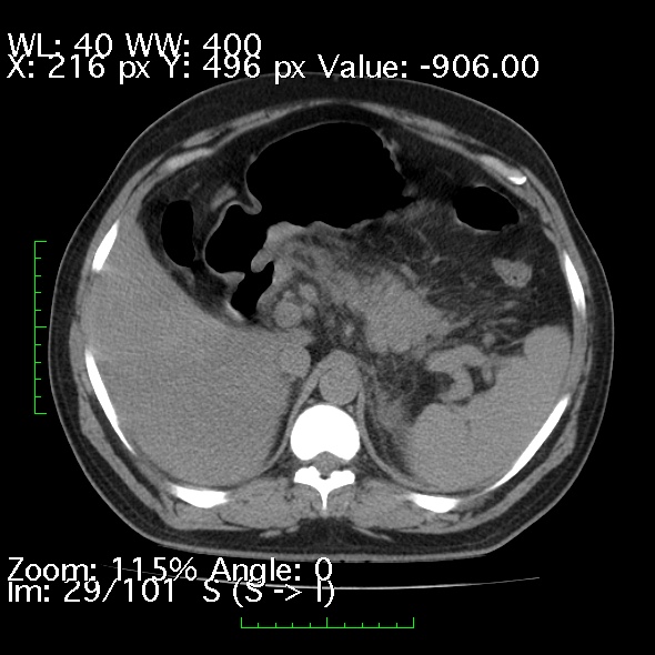 Acute pancreatitis (Radiopaedia 34043-35276 Axial non-contrast 29).jpg