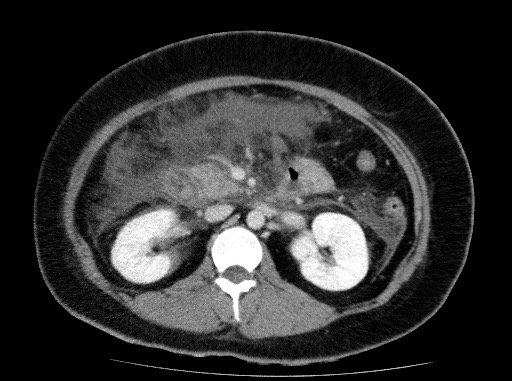 Acute pancreatitis (Radiopaedia 69236-79012 Axial C+ portal venous phase 39).jpg