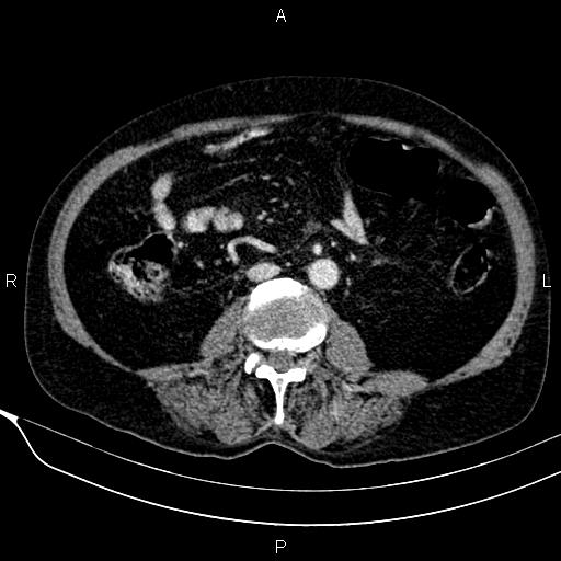 Acute pancreatitis (Radiopaedia 85146-100701 Axial C+ portal venous phase 38).jpg