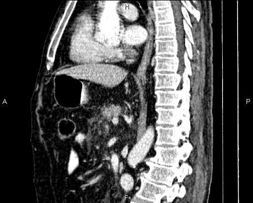 Acute pancreatitis (Radiopaedia 85146-100701 Sagittal C+ portal venous phase 49).jpg