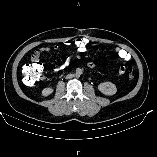 Acute pancreatitis (Radiopaedia 85390-101010 Axial C+ delayed 48).jpg
