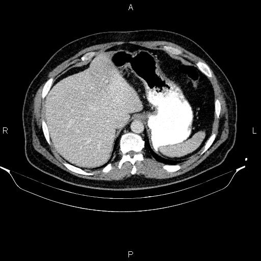 File:Acute pancreatitis (Radiopaedia 85390-101010 Axial C+ portal venous phase 19).jpg