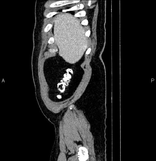 Acute pancreatitis (Radiopaedia 85390-101010 Sagittal C+ portal venous phase 4).jpg