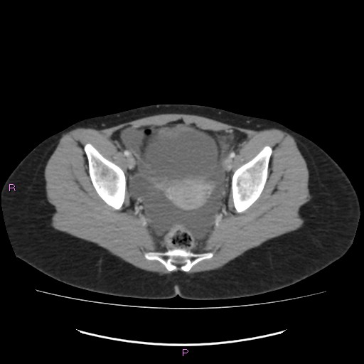 Acute pancreatitis secondary to stone at minor papilla and pancreatic divisum (Radiopaedia 76570-88333 Axial C+ portal venous phase 70).jpg