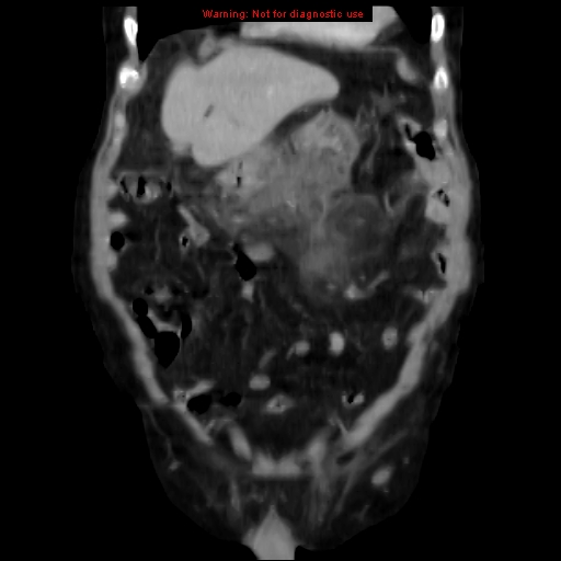 Acute pancreatitis with incidental pancreatic lipoma (Radiopaedia 10190-10730 Coronal C+ portal venous phase 17).jpg