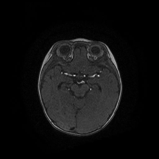 Acute phase of hemiconvulsion-hemiplegia epilepsy syndrome (Radiopaedia 29309-29745 Axial TOF angiography 78).jpg
