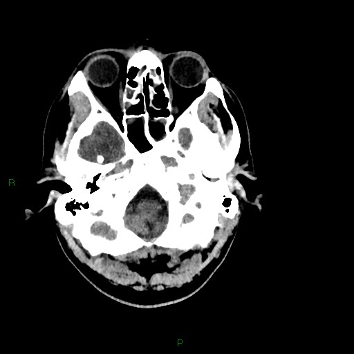 File:Acute posterior cerebral artery territory infarct (Radiopaedia 79329-92393 Axial non-contrast 16).jpg