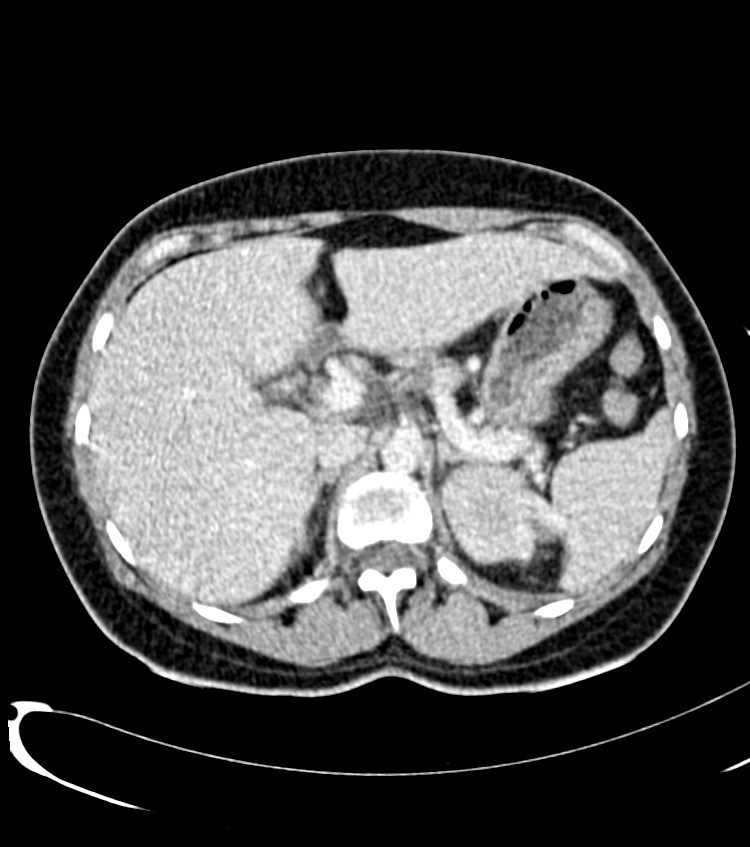 Acute pyelonephritis (Radiopaedia 40264-42816 Axial C+ portal venous phase 4).jpg