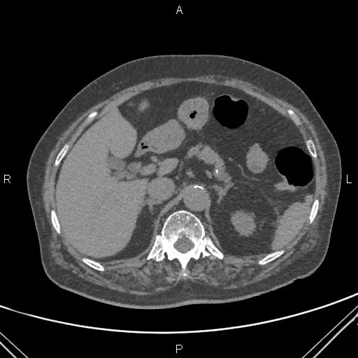 Acute renal artery occlusion (Radiopaedia 86586-102682 Axial non-contrast 19).jpg