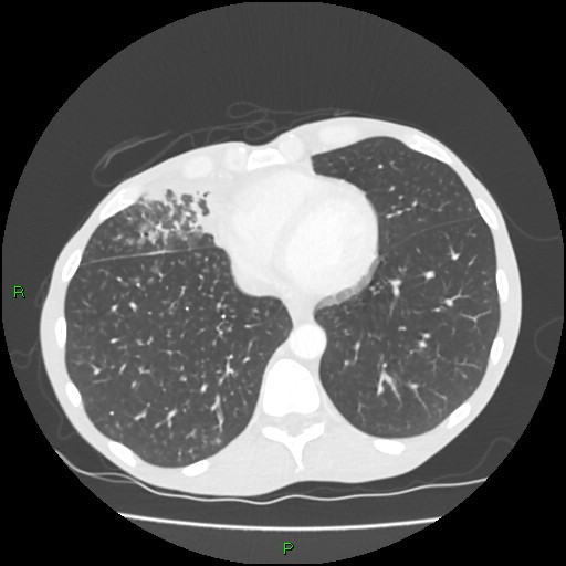 File:Acute right lung abscess (Radiopaedia 34806-36258 Axial lung window 137).jpg