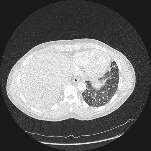 Acute segmental pulmonary emboli and pulmonary infarction (Radiopaedia 62264-70444 Axial lung window 159).jpg