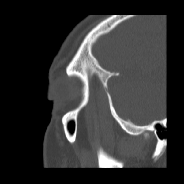 Acute sinusitis (Radiopaedia 23161-23215 Sagittal bone window 55).jpg