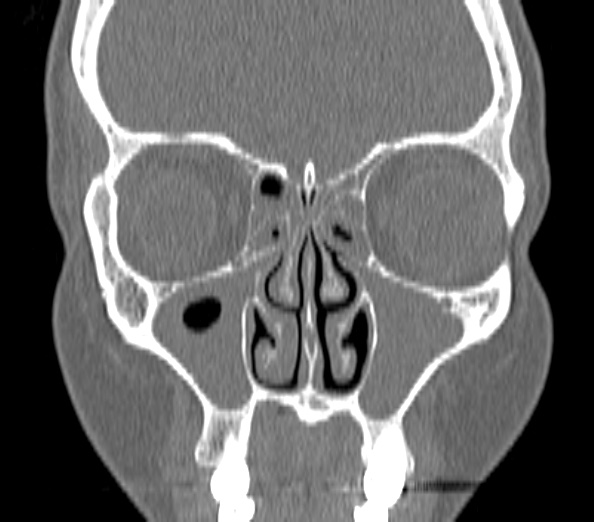 Acute sinusitis (Radiopaedia 40564-43158 Coronal bone window 14).jpg