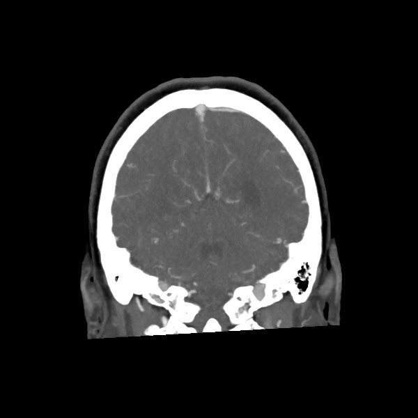 File:Acute subarachnoid hemorrhage and accessory anterior cerebral artery (Radiopaedia 69231-79009 Coronal C+ arterial phase 59).jpg