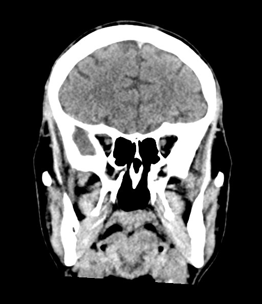 File:Acute superior cerebellar artery territory infarct (Radiopaedia 84104-99359 Coronal non-contrast 35).jpg