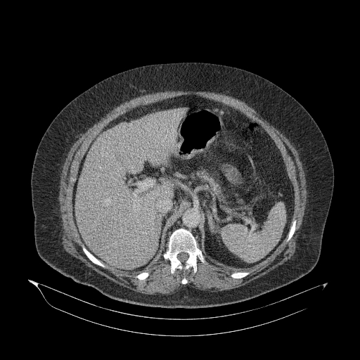 Acute superior mesenteric artery occlusion (Radiopaedia 51288-56960 Axial C+ portal venous phase 29).jpg