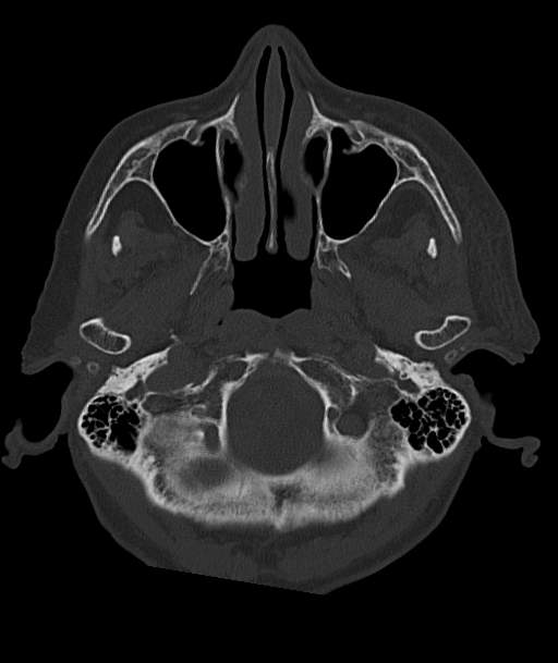 Acute traumatic subdural hematoma (Radiopaedia 82921-97257 Axial bone window 93).jpg