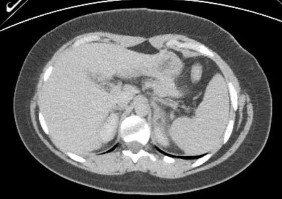 File:Acute unilateral nonhemorrhagic adrenal infarction (Radiopaedia 67560-76957 Axial renal excretory phase 22).jpg