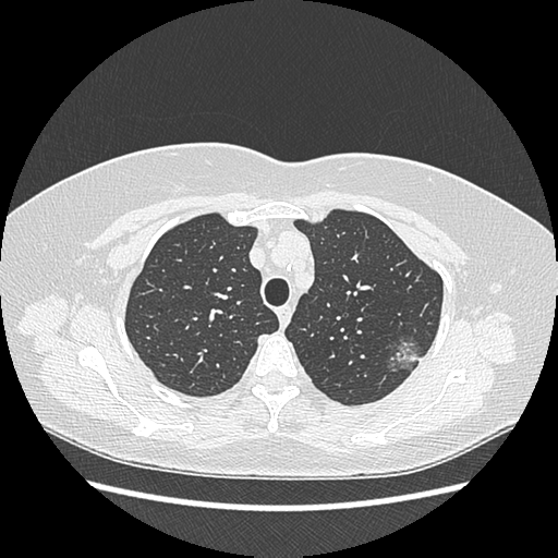 Adenocarcinoma in situ of lung (Radiopaedia 38685-40829 B 55).png