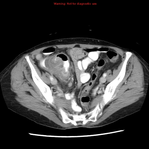 File:Adenocarcinoma of the colon (Radiopaedia 8191-9039 Axial liver window 61).jpg