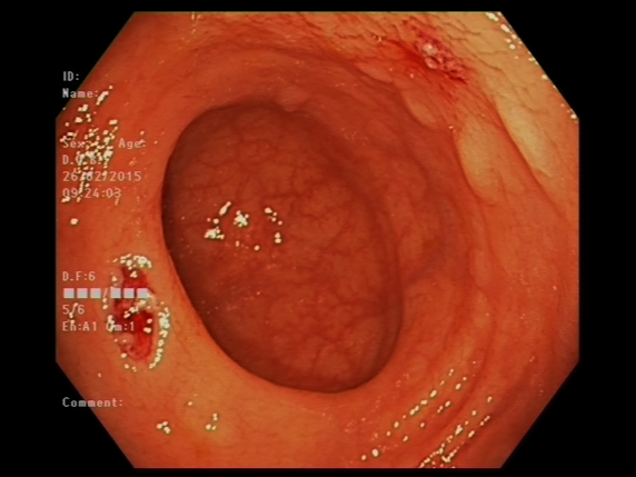 File:Adenocarcioma of rectum- T1 lesion (Radiopaedia 36921-38553 A 3).png
