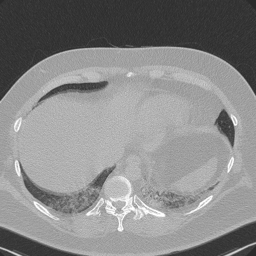 Adenoid cystic carcinoma of the trachea (Radiopaedia 49042-54137 Axial lung window 283).jpg