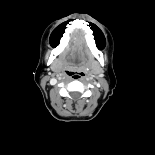 File:Adenoid cystic tumor of palate (Radiopaedia 46980-51518 Axial C+ delayed 38).png