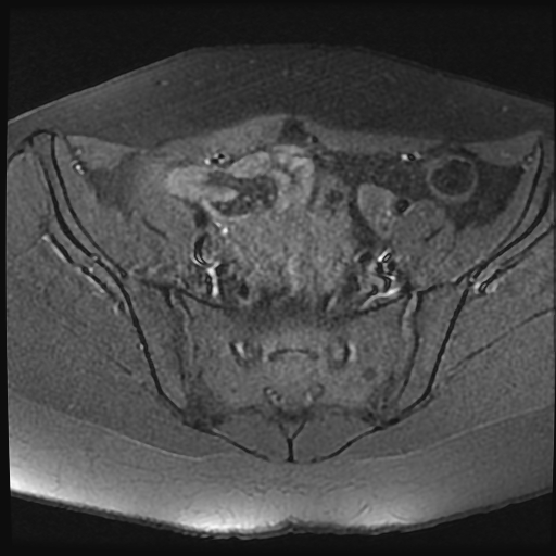 File:Adenomyosis-scar endometriosis (Radiopaedia 65863-75022 Axial T1 fat sat 7).jpg