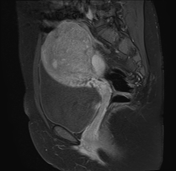 File:Adenomyosis - ovarian endometriomas (Radiopaedia 67031-76350 Sagittal T1 C+ fat sat 10).jpg