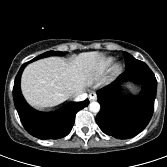 File:Adhesional small bowel obstruction (Radiopaedia 48397-53305 Axial C+ portal venous phase 4).jpg