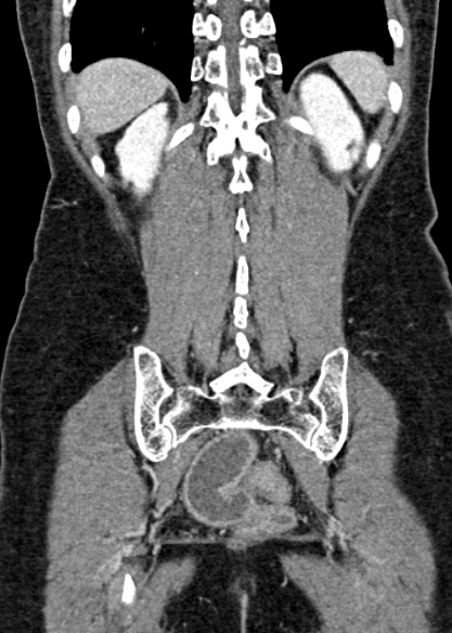Adhesional small bowel obstruction (Radiopaedia 48397-53305 Coronal C+ portal venous phase 286).jpg